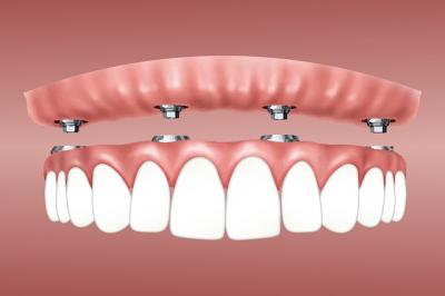 overdenture 3597628_640 1 